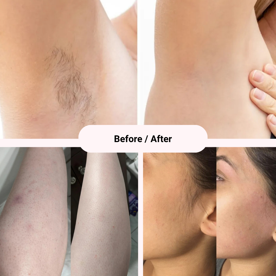 Removely IPL 3+ (Try & Buy Spain)