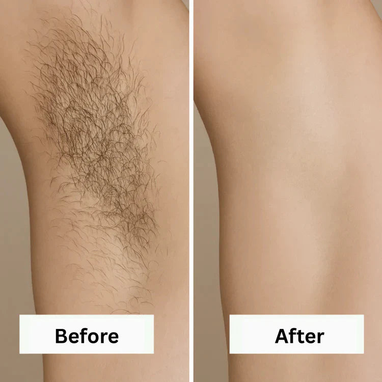 Removely IPL 3+ (Try & Buy Spain)