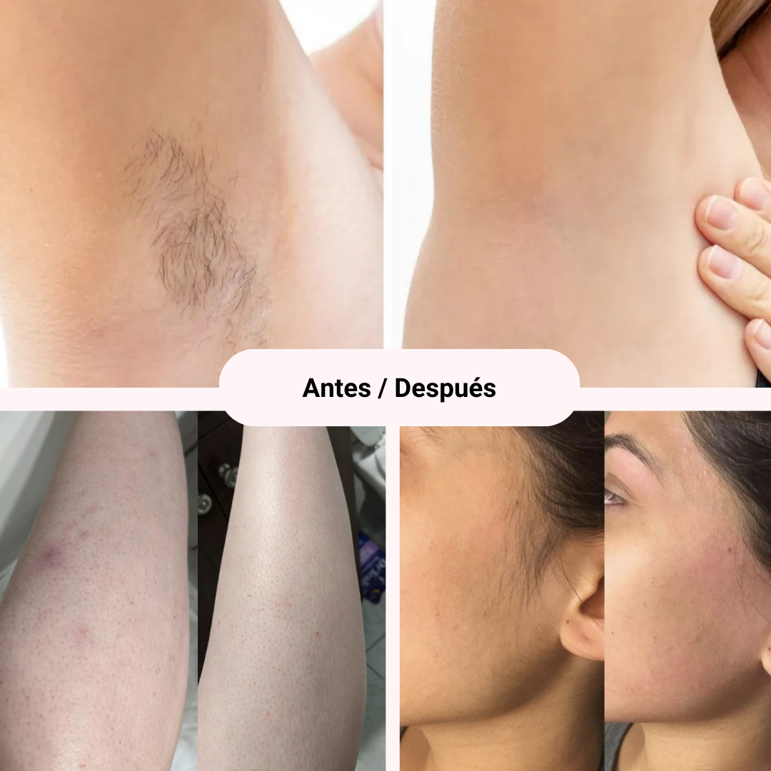 Removely IPL 3+ (Try & Buy Spain)